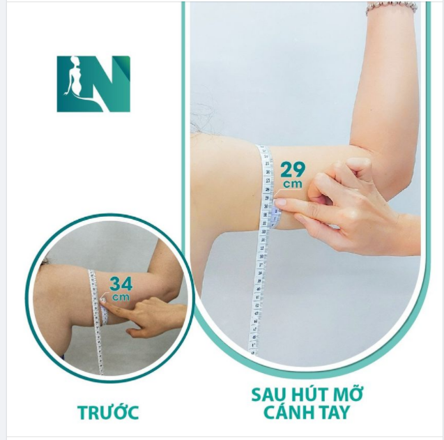 CÁNH TAY CÓ THAY ĐỔI SAU CA HÚT MỠ KHÔNG