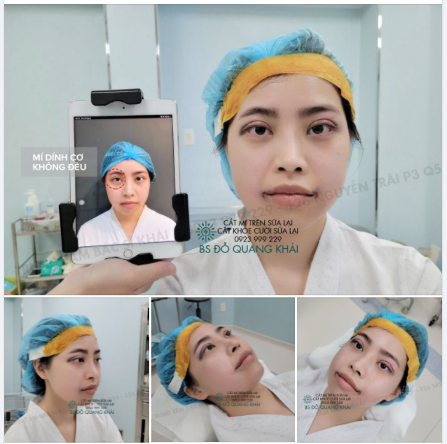 CẬP NHẬT NHANH KQ CẮT MÍ TRÊN + CẮT KHÓE CƯỜI SỬA LẠI