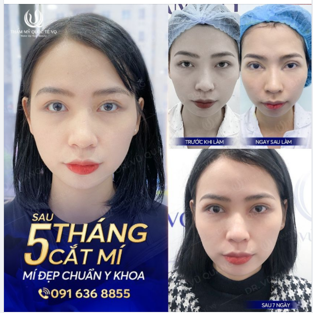 Cắt mí Baby West 9D Dành cho những ai muốn cắt mí nhưng sợ đau, sợ tốn thời gian nghỉ dưỡng.