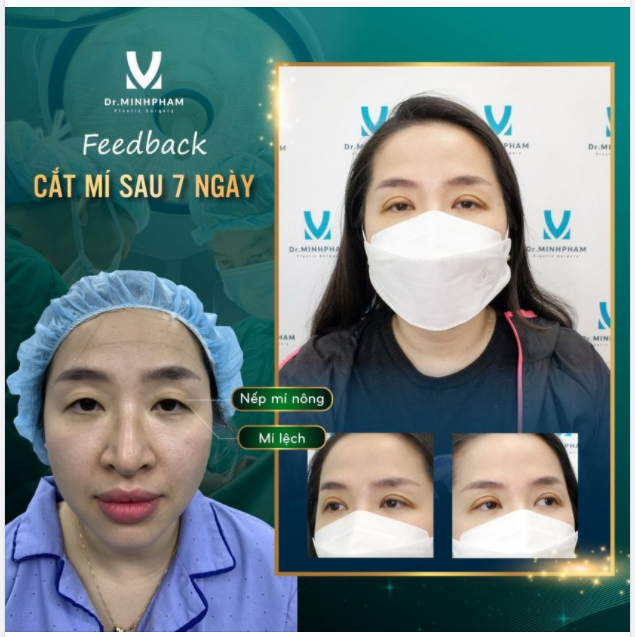 Cắt mí chỉ là thủ thuật nhỏ, làm ở spa cũng được