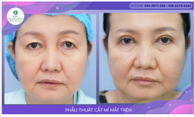 Cắt mí mắt ở người lớn tuổi khi thẩm mỹ cũng là điều trị
