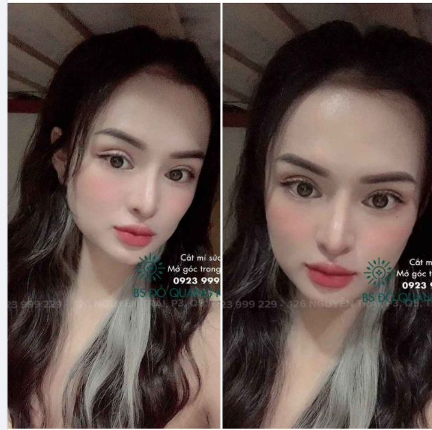 CẮT MÍ TRÊN SỬA LẠI + MỞ GÓC MẮT TRONG