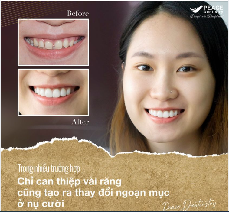 CẮT NƯỚU & DÁN 4 MẶT SỨ VENEER