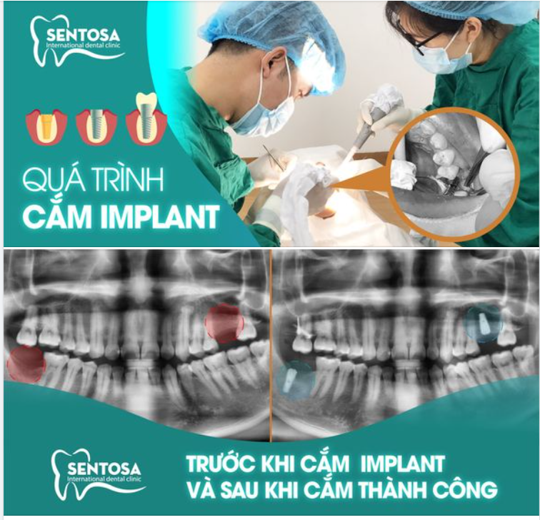 CẤY GHÉP IMPLANT GIẢI PHÁP HIỆU QUẢ NHẤT CHO TRƯỜNG HỢP MẤT RĂNG .
