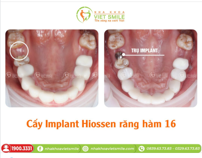 CẤY GHÉP IMPLANT HIOSSEN RĂNG HÀM 16