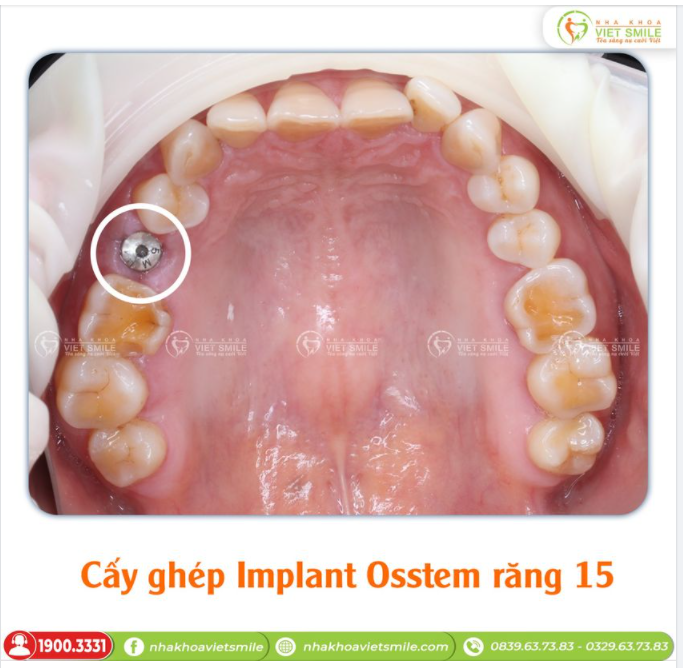 CẤY GHÉP IMPLANT OSSTEM RĂNG 15