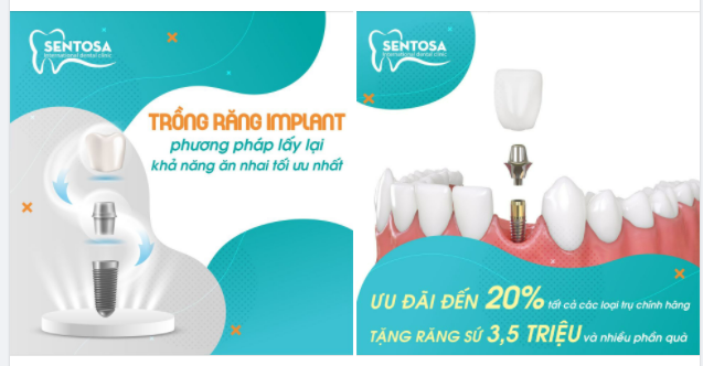 CẤY GHÉP IMPLANT - PHƯƠNG PHÁP THAY THẾ RĂNG MẤT HOÀN HẢO