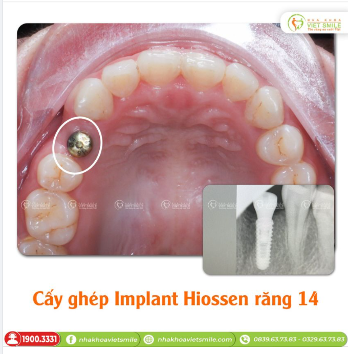 CẤY GHÉP IMPLANT RĂNG 14 - CẢI THIỆN THẨM MỸ