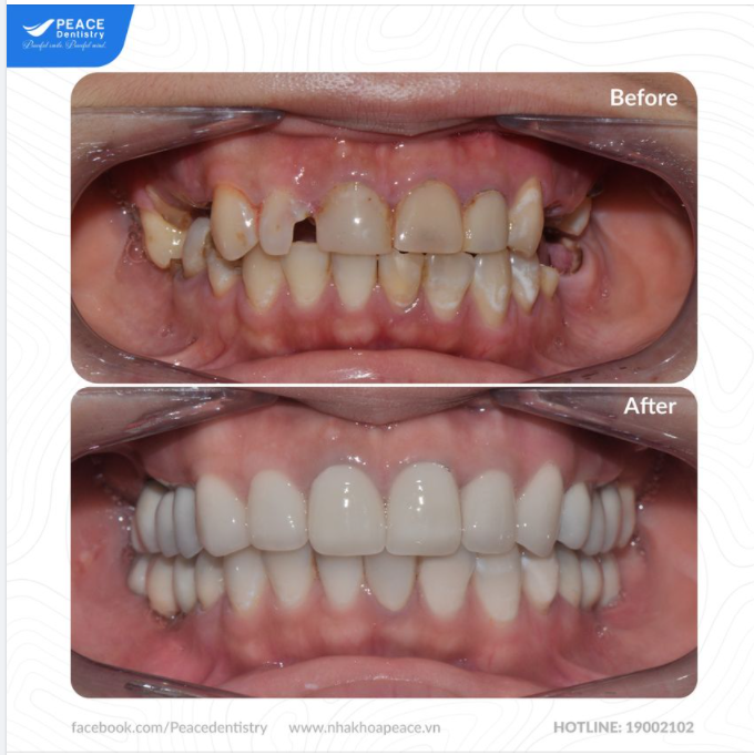 Cấy ghép Implant và phục hình răng sứ giúp khôi phục trọn vẹn chức năng ăn nhai và thẩm mỹ răng miệng