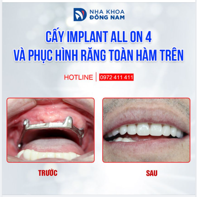CẤY IMPLANT ALL ON 4 TOAN HÀM ĂN UỐNG NGON MIỆNG, LẠI TIẾT KIỆM CHI PHÍ