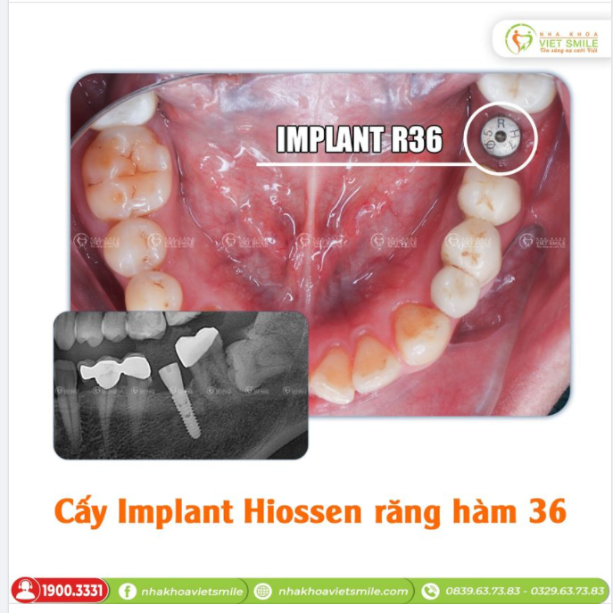 CẤY IMPLANT HIOSSEN RĂNG HÀM 36