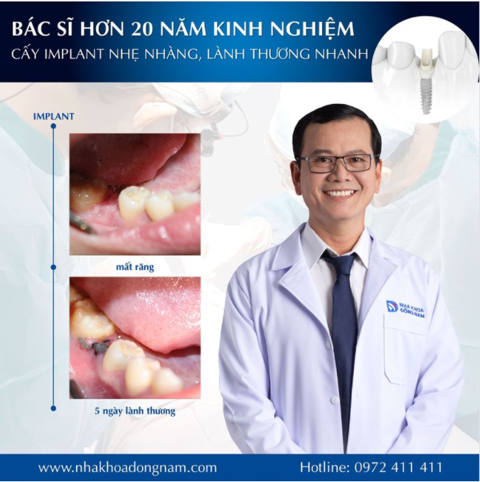 CẤY IMPLANT NHẸ NHÀNG, NHANH LÀNH THƯƠNG KHI VÀ CHỈ KHI
