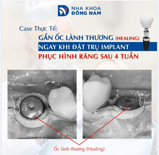 CẤY IMPLANT TRONG 4 TUẦN CHO CHỊ J. KIM (Việt Kiều Úc)