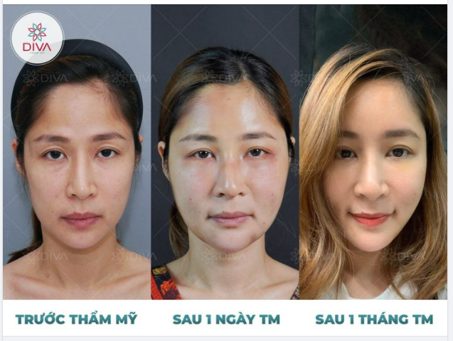 CẤY MỠ COLEMAN TRÁN CẢI THIỆN TRÁN LÕM, HỒI XUÂN TỰ NHIÊN