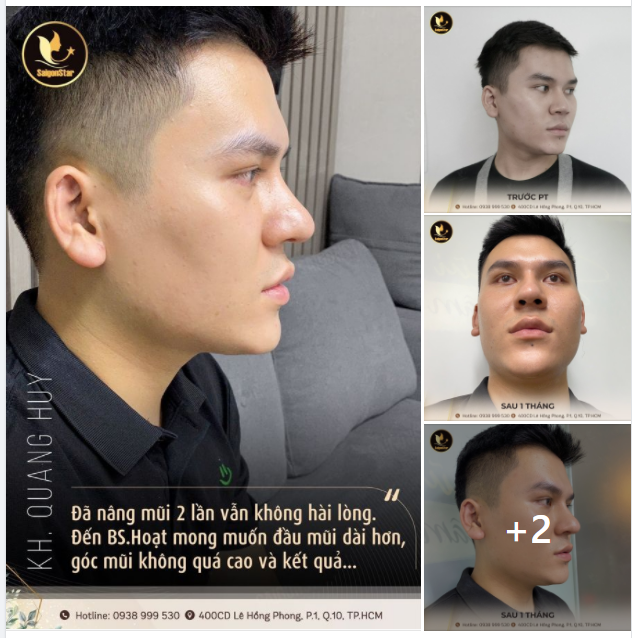Chàng trai đã nâng mũi 2 lần nhưng không hài lòng. Đến Bs.Hoạt sửa lại, mong muốn đầu mũi dài hơn, góc mũi không quá cao...