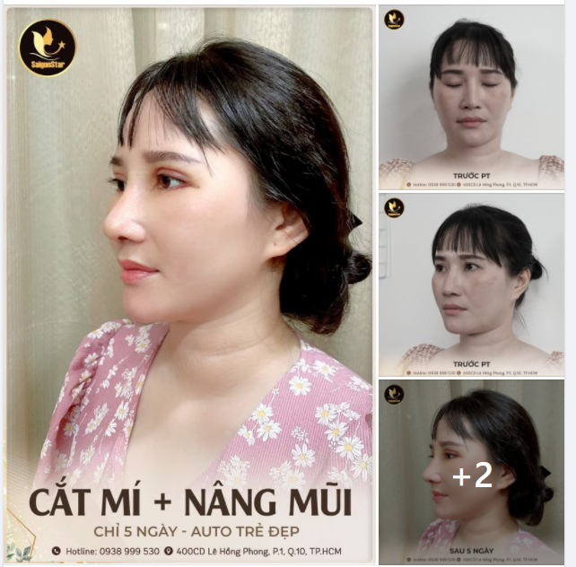 CHỈ 5 NGÀY CẮT MÍ MẮT + NÂNG MŨI, KH AUTO TRẺ ĐẸP