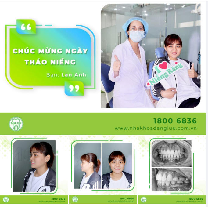 Chỉ cần Niềng răng thành công, bạn sẽ có một hàm răng đều đặn, khớp cắn chuẩn & nụ cười đẹp!