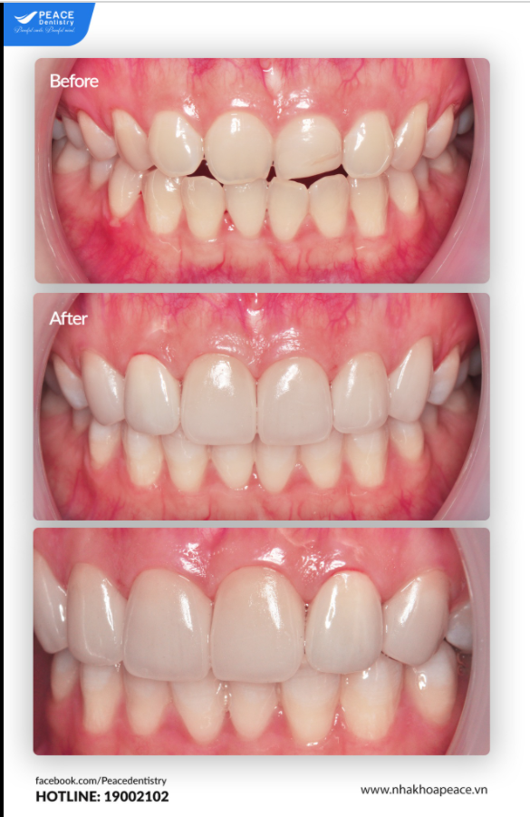 CHỈ ĐỊNH MẶT DÁN SỨ VENEER NON-PREP