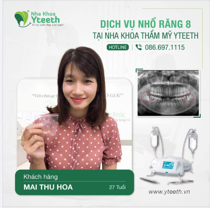 Chị Hoa 27 tuổi nhổ 2 răng số 8 hàm dưới mọc lệch đâm vào răng số 7 chỉ sau 15 phút cho cả 2 chiếc răng.