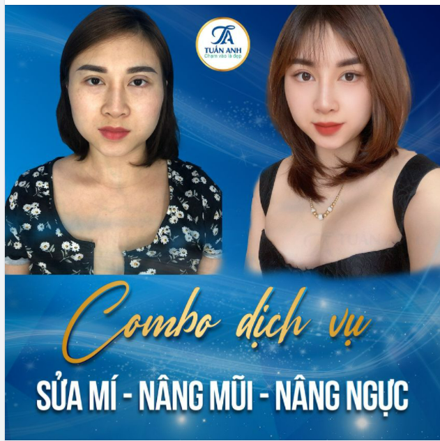 Chị Linh sau khi cắt mí bị hỏng tại cơ sở khác đã tìm tới Thẩm Mỹ Tuấn Anh để được bác sĩ sửa lại, đồng thời thực hiện dịch vụ Combo Nâng ngực Treo sa trễ độ 2