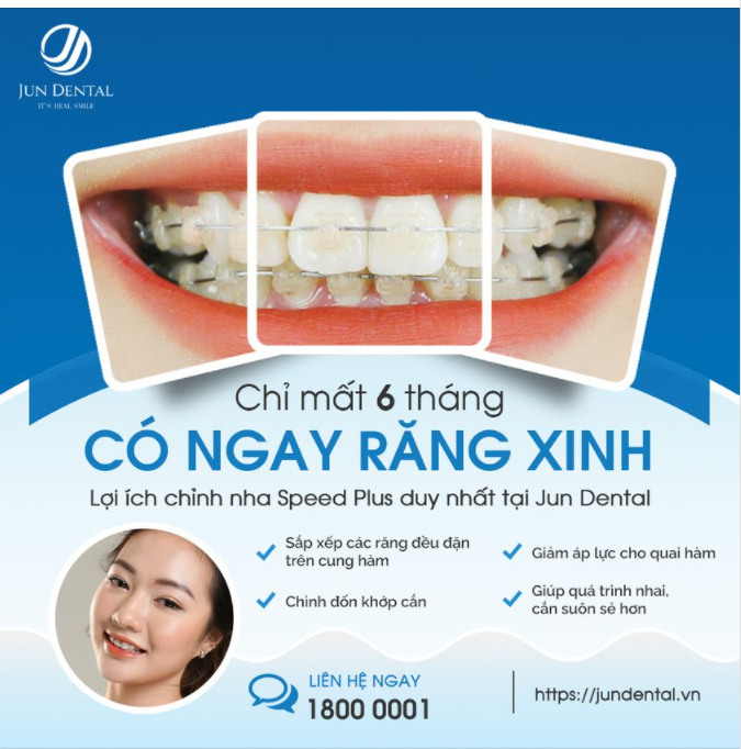 CHỈ MẤT 6 THÁNG CÓ NGAY RĂNG XINH
