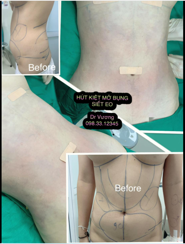 Chỉ mới hút kiệt mỡ với Dr Vương đã siết được eo, tạo eo con kiến  nhẹ nhàng, hiệu quả kinh tế !