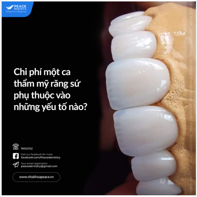 CHI PHÍ MỘT CA THẨM MỸ RĂNG SỨ PHỤ THUỘC VÀO NHỮNG YẾU TỐ NÀO 