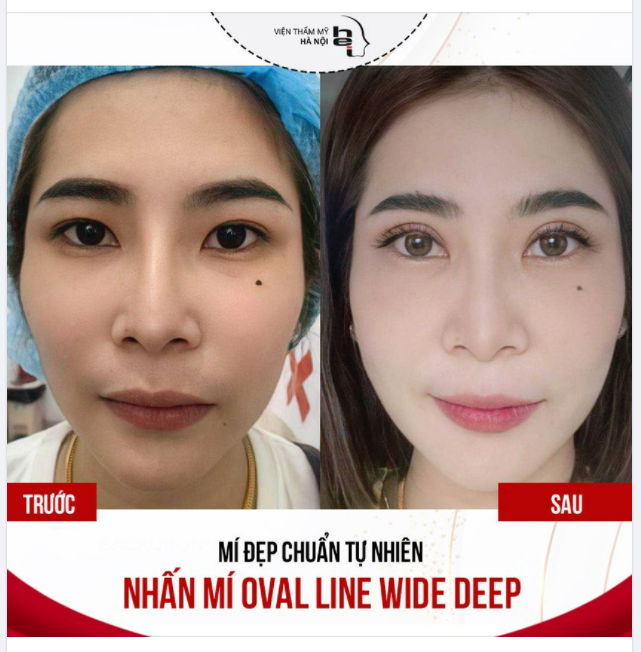​​​​​​​ Chỉ sau 30P thực hiện Nhấn mí Oval Line Wide Deep đôi mắt của chị đã thay đổi hoàn toàn