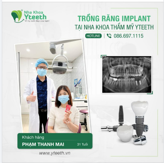 Chị Thanh Mai 31t sau khi cắm 2 chiếc Implant