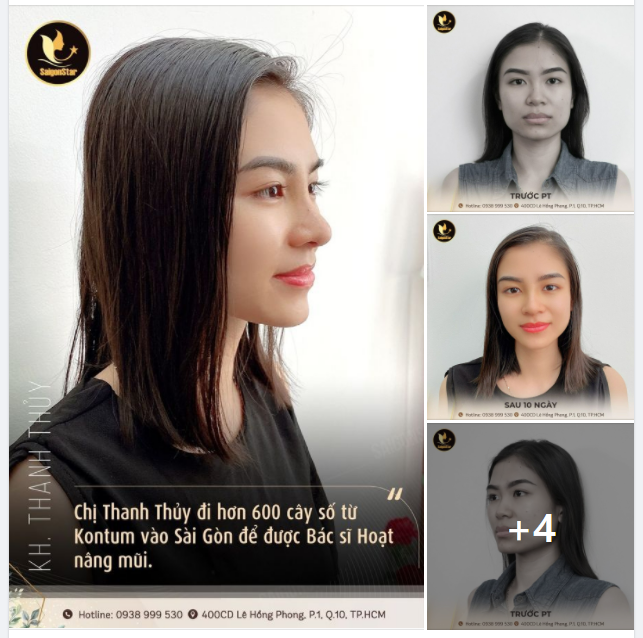 Chị Thanh Thủy đi hơn 600 cây số từ Kon Tum vào Sài Gòn để được bác sĩ Hoạt nâng mũi