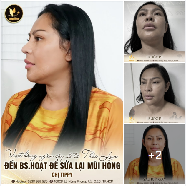 Chị Tippy vượt hàng ngàn cây số từ Thái Lan đến Việt Nam gặp Bs.Hoạt để sửa lại mũi hỏng