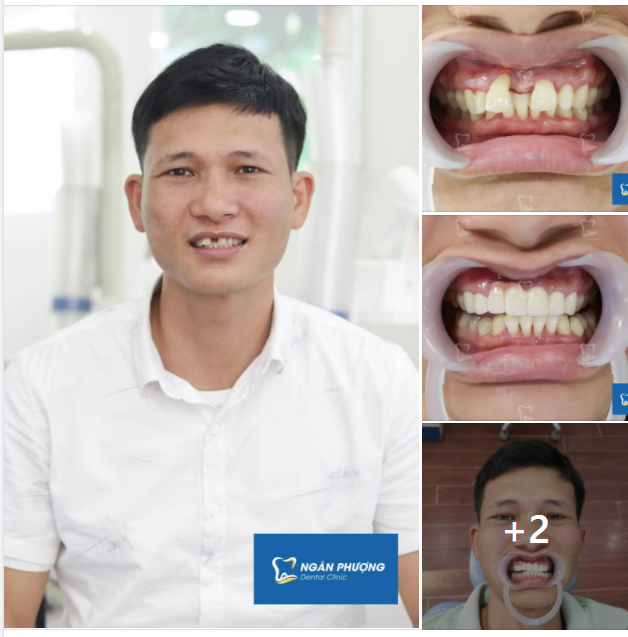 Chỉ với 3 ngày làm răng tại Ngân Phượng, mang về ngay nụ cười tuấn mỹ