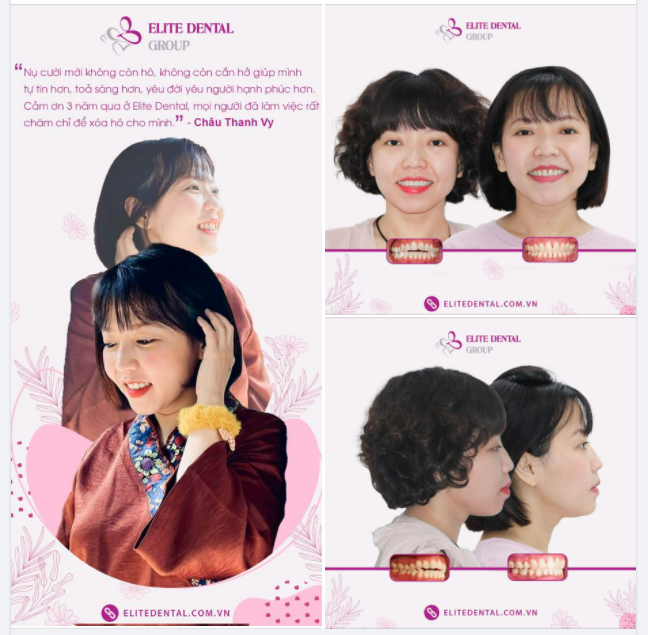 CHỈNH NHA CÓ THỂ THAY ĐỔI GƯƠNG MẶT CỦA BẠN NHƯ THẾ NÀO