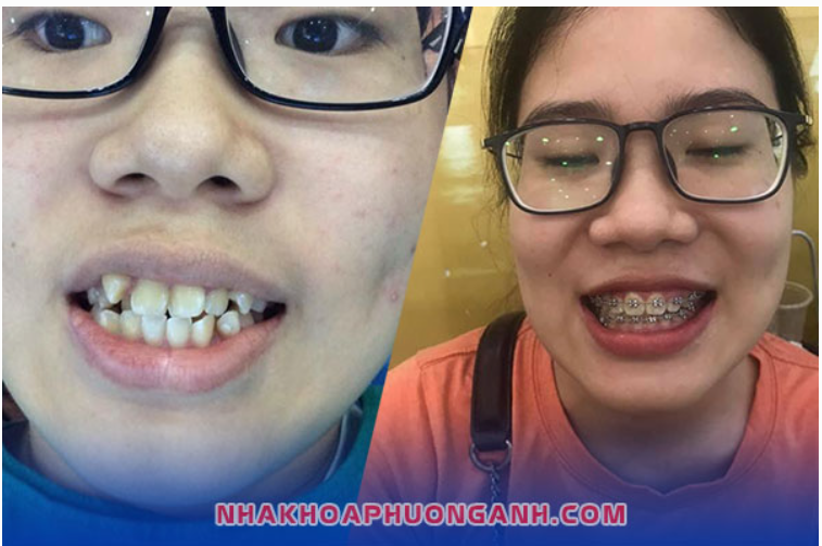 Chỉnh nha, niềng răng không chỉ vì ngoại hình