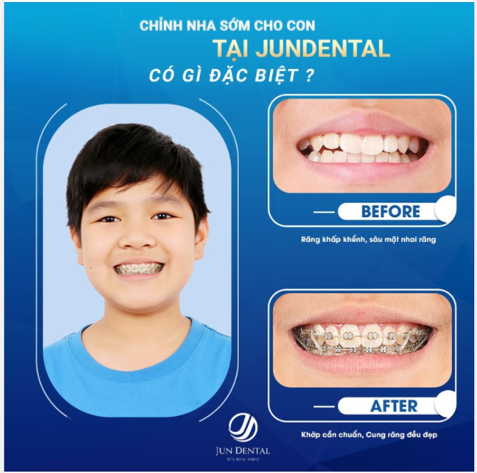 CHỈNH NHA SỚM CHO CON - ĐỊNH HÌNH KHUÔN MẶT HÀI HÒA, CÂN ĐỐI