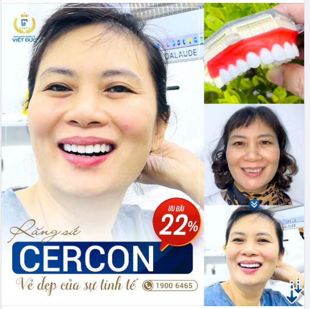 CHINH PHỤC NỤ CƯỜI HOÀN HẢO CÙNG SỨ CERCON