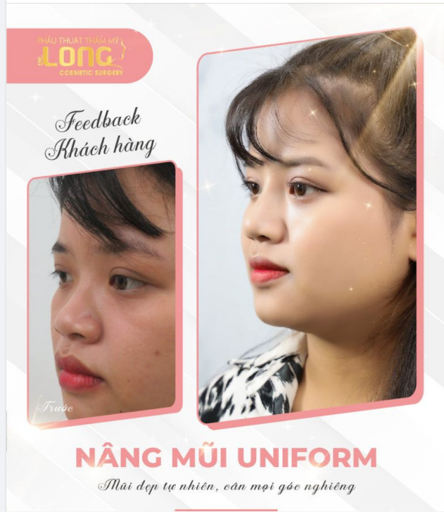 CHO EM “ORDER” MỘT DÁNG MŨI XINH THANH THOÁT KHỎI SỰ TỰ TI