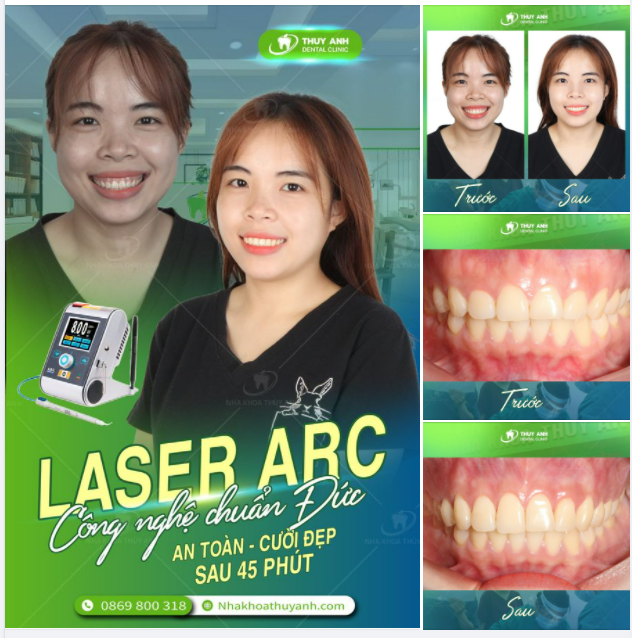 CHỮA CƯỜI HỞ LỢI - CHỮA MỘT LẦN, ĐẸP MÃI MÃI