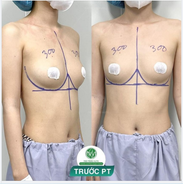 CHUẨN BỊ CHO MỘT CA NÂNG NGỰC ĐẦU GIỜ CHIỀU