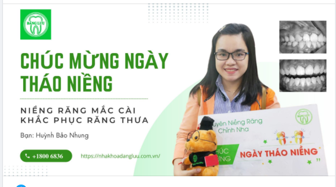 Chúc mừng bạn Bảo Nhung đã có hàm răng đều đặn, khớp cắn chuẩn.