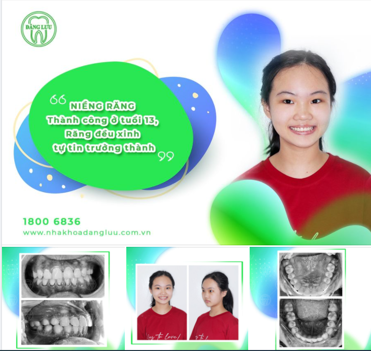 Chúc mừng bạn Cát Tường đã niềng răng thành công ở tuổi 13