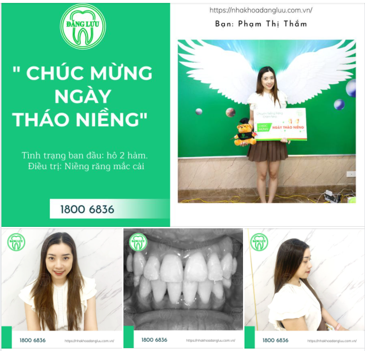 Chúc mừng bạn đã có hàm răng đều đặn, nụ cười rạng rỡ & khuôn mặt hài hòa hơn.