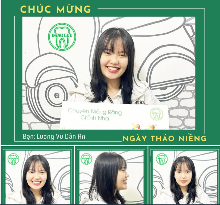 Chúc mừng bạn Dân An đã Niềng răng thành công tại Nha Khoa Đăng Lưu!