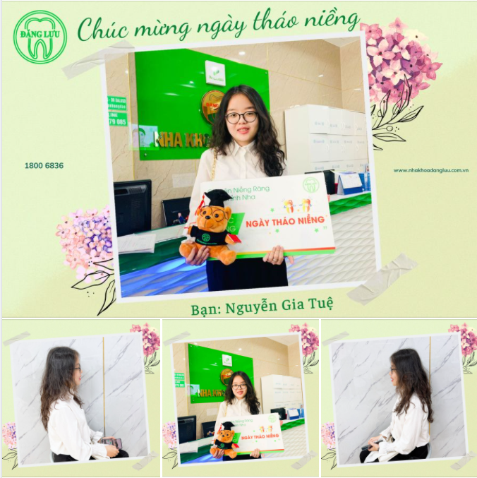 Chúc mừng bạn Gia Tuệ đã kết thúc hành trình niềng răng của mình tại Nha Khoa Đăng Lưu.