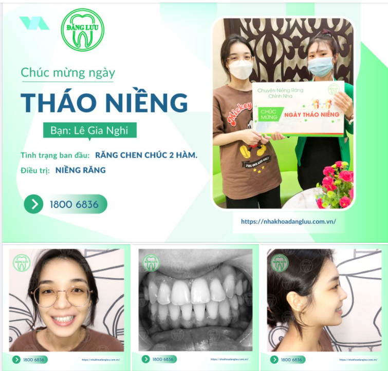 Chúc mừng bạn Lê Gia Nghi đã trở thành người nằm trong top 15000+++ ca niềng răng thành công tại Hệ thống Nha Khoa Đăng Lưu!