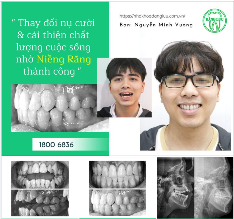 Chúc mừng bạn Minh Vương đã niềng răng thành công tại Hệ thống Nha Khoa Đăng Lưu