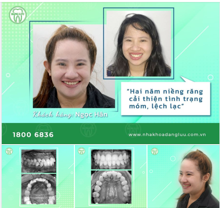 Chúc mừng bạn Ngọc Hân đã niềng răng thành công tại Hệ thống Nha Khoa Đăng Lưu sau 2 năm