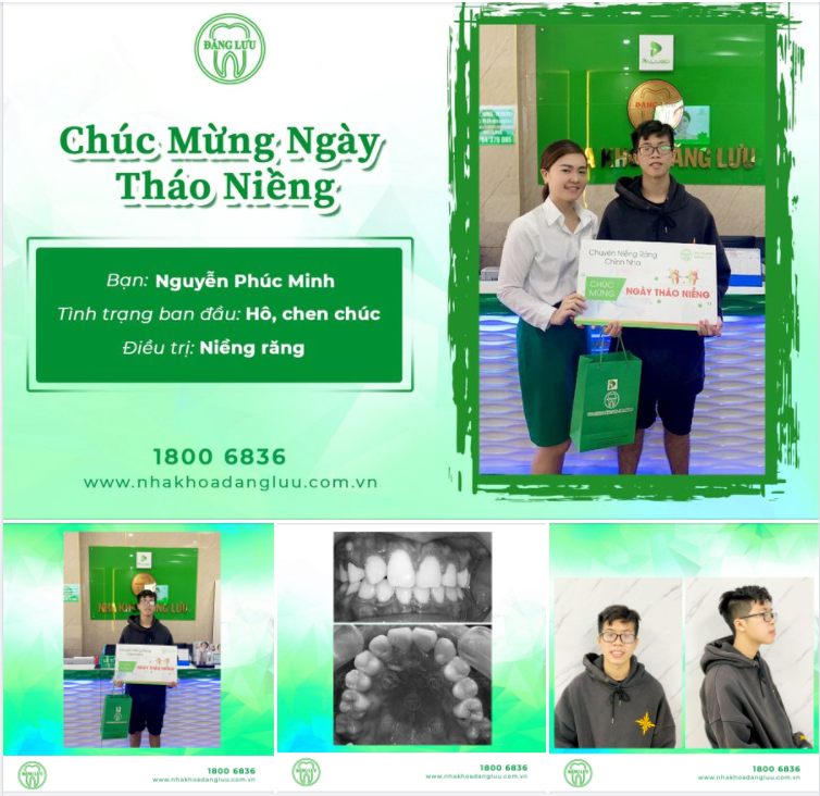 Chúc mừng bạn Phúc Minh đã niềng răng thành công tại Nha Khoa Đăng Lưu!
