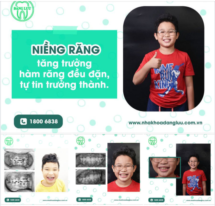 Chúc mừng bé Trương Thế vinh vừa hoàn thành quá trình chỉnh nha can thiệp sắp đều răng trong vòng 4 tháng tại Hệ thống Nha Khoa Đăng Lưu