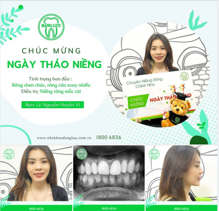 Chúc mừng nụ cười thứ 15000+ được kiến tạo thành công nhờ niềng răng tại Nha Khoa Đăng Lưu!